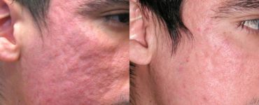 Can doxycycline fade acne scars?