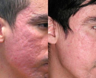 Can doxycycline fade acne scars?