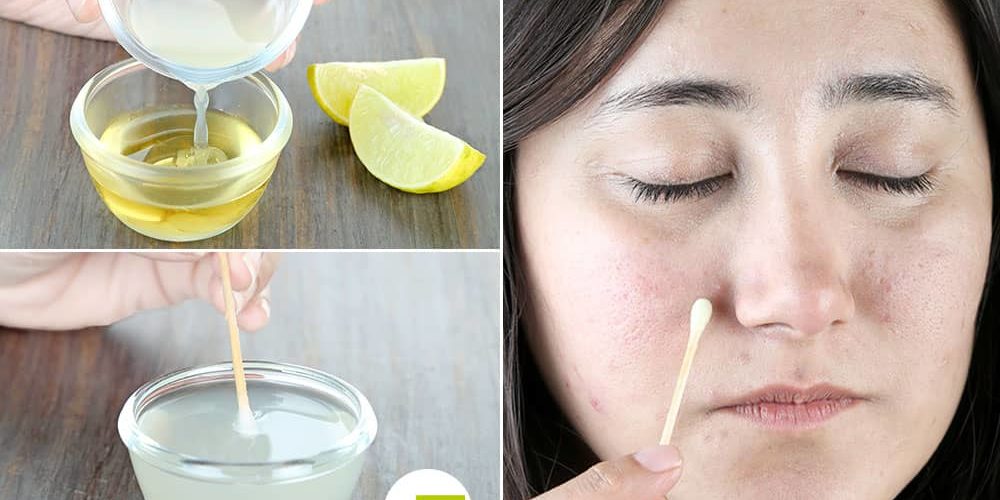 Can lemon remove dark spots?