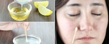 Can lemon remove dark spots?