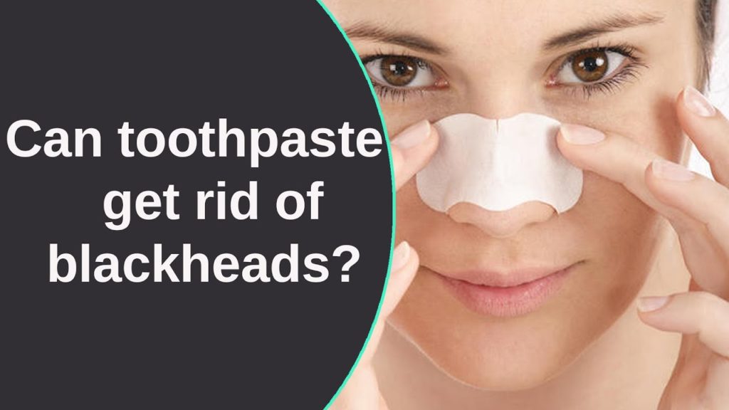 Can toothpaste get rid of whiteheads?