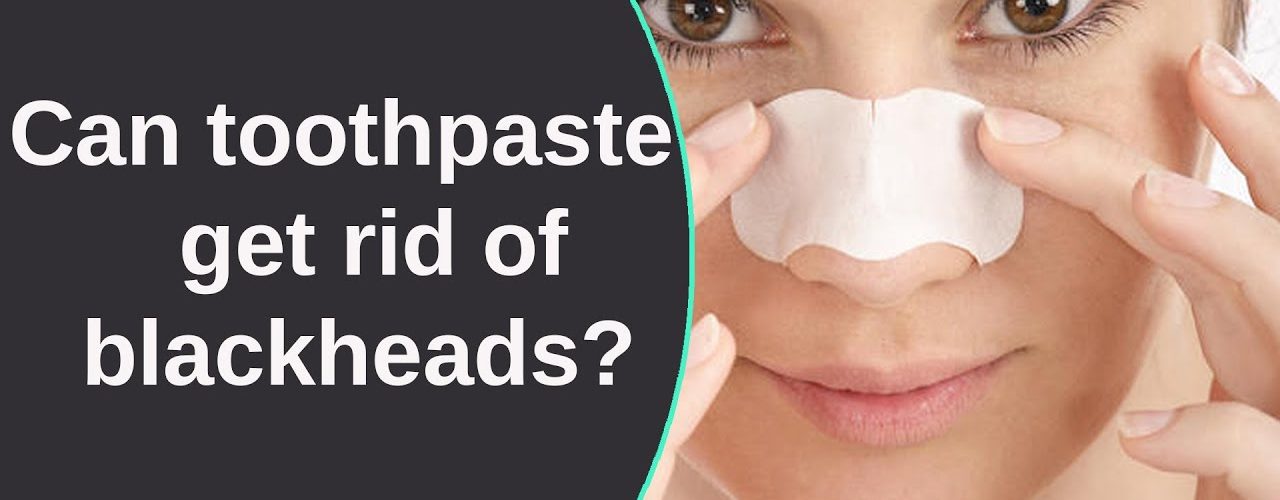 Can toothpaste get rid of whiteheads?