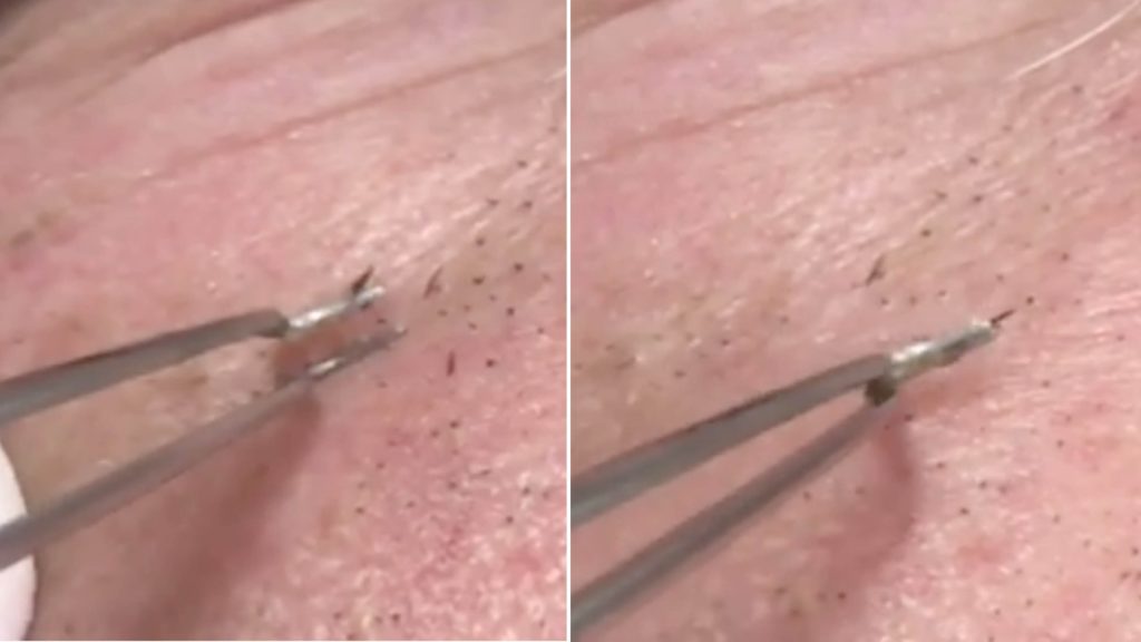 Can you remove blackheads with tweezers?