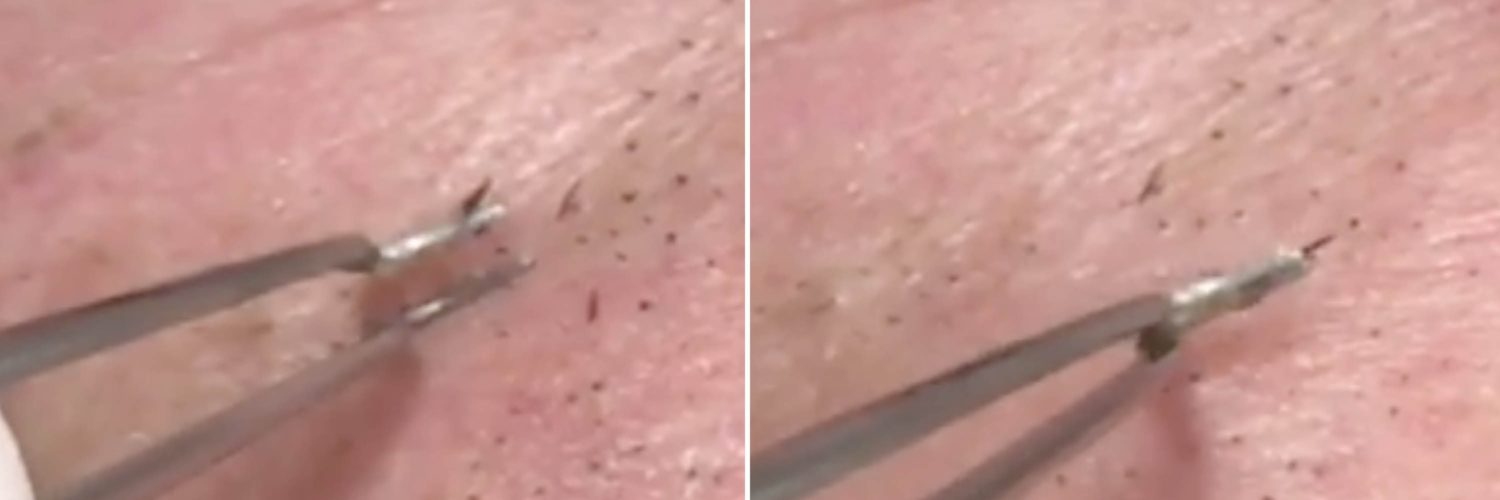 Can you remove blackheads with tweezers?