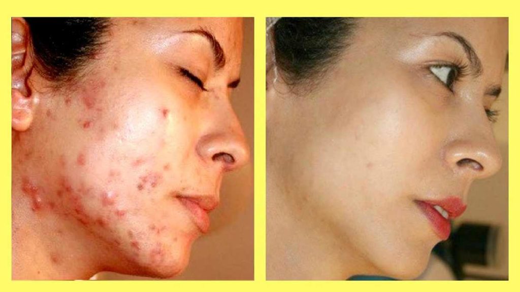 Do pimple marks go away naturally?