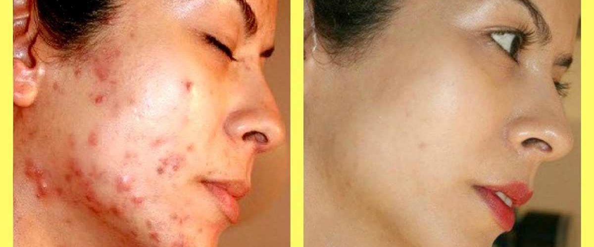 Do Pimple Marks Go Away Naturally 