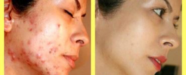 Do pimple marks go away naturally?