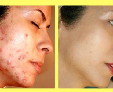 Do pimple marks go away naturally?