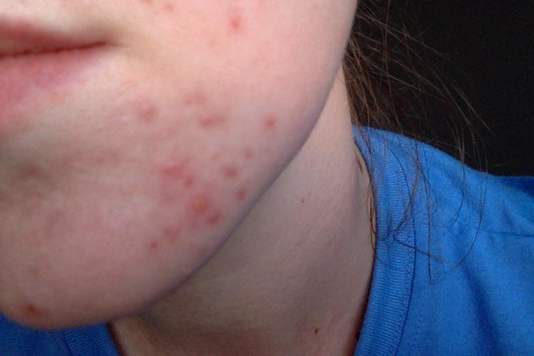 Does hormonal acne ever go away?