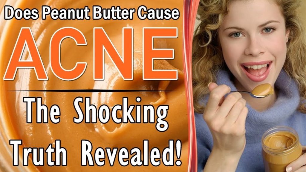 Does powdered peanut butter cause acne?