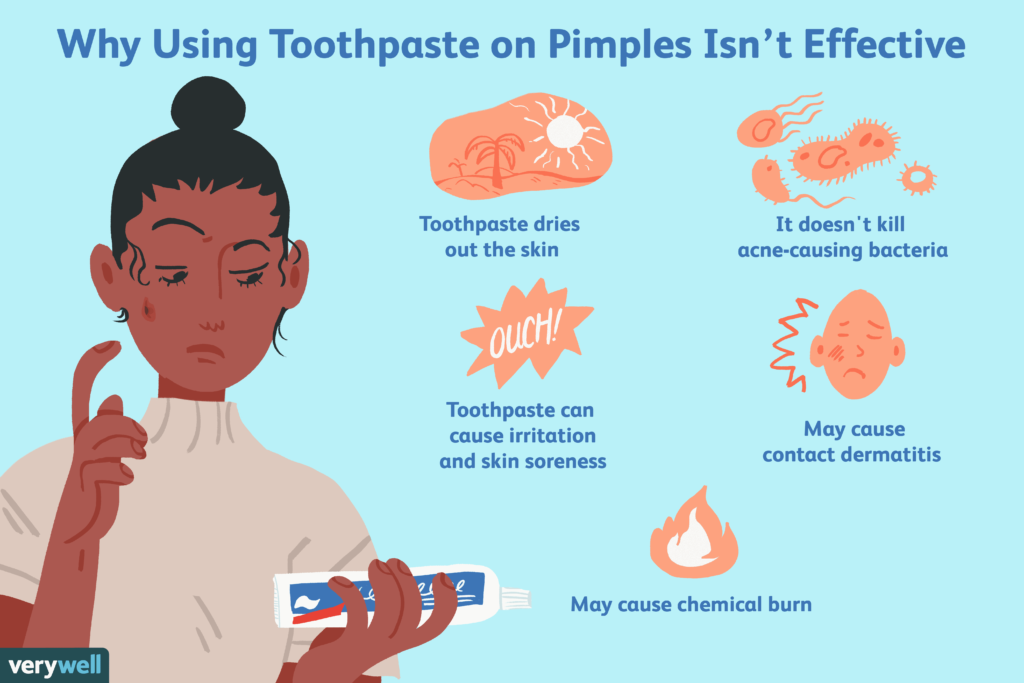 Does toothpaste work on pimples?