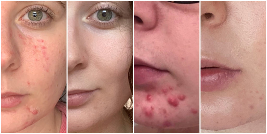 How can I clear up acne fast?