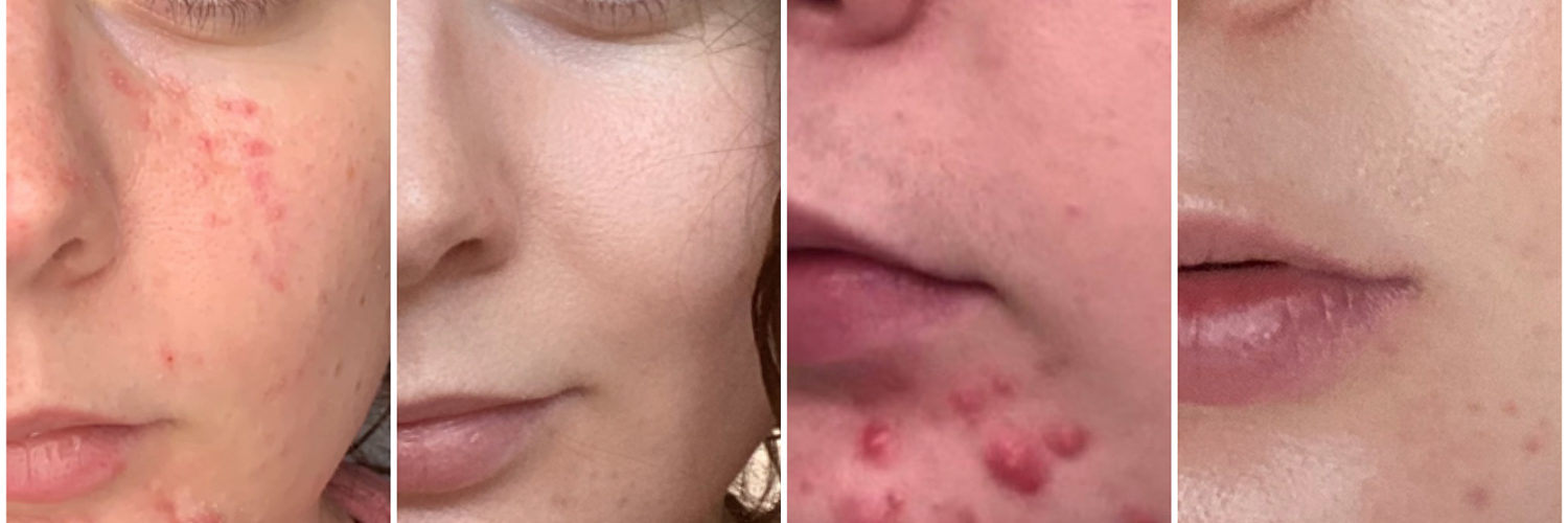 How can I clear up acne fast?