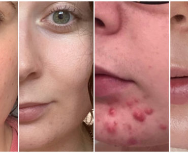 How can I clear up acne fast?