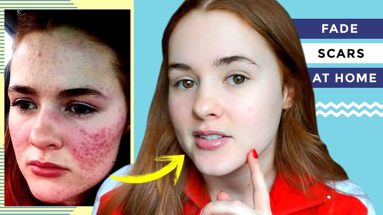 how to remove acne permanently in 7 days