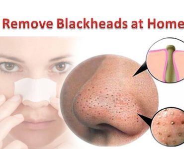 How can I remove black heads?