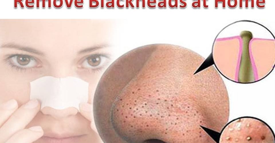 How can I remove black heads?