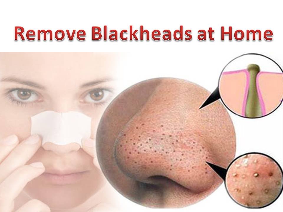 How can I remove black heads?