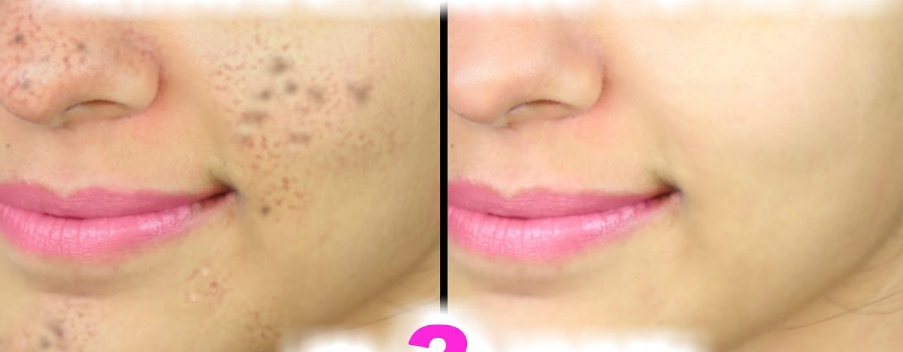 How can I remove dark spots and blemishes on my face?