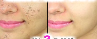 How can I remove dark spots and blemishes on my face?