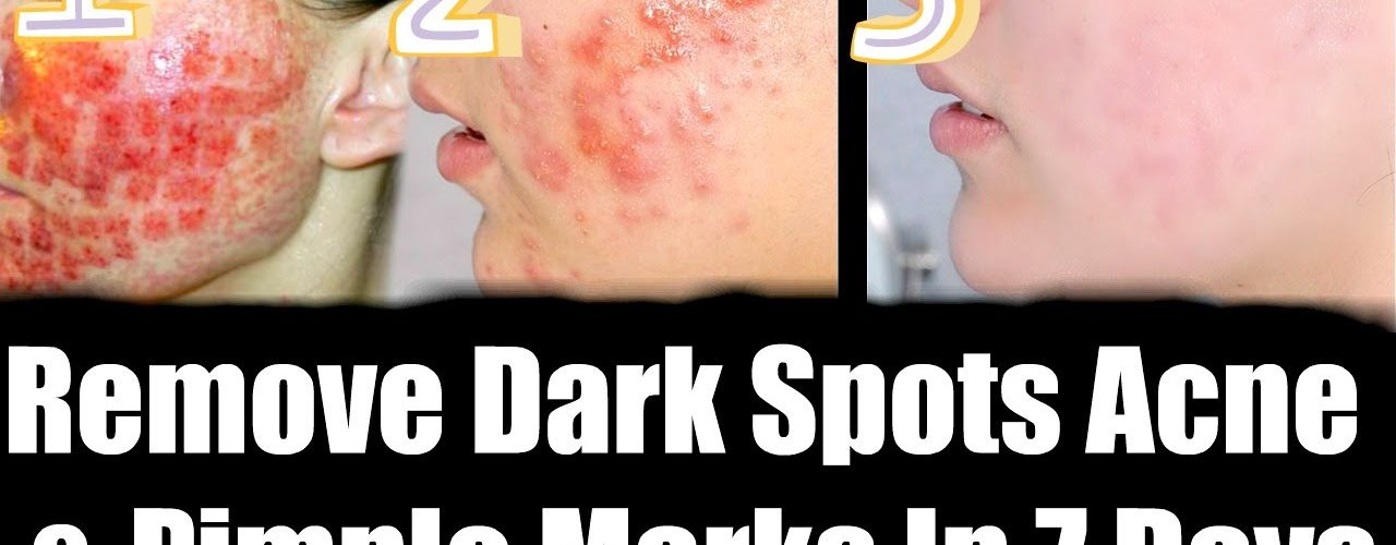 How can I remove dark spots in 7 days?