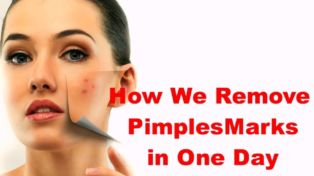 How can I remove pimple marks?