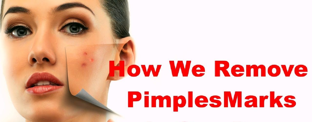 How can I remove pimple marks?