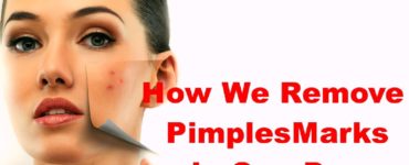 How can I remove pimple marks?
