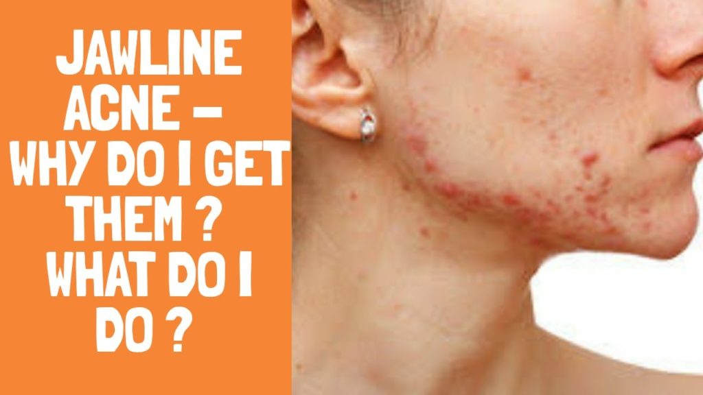 How do I stop acne on my jawline?