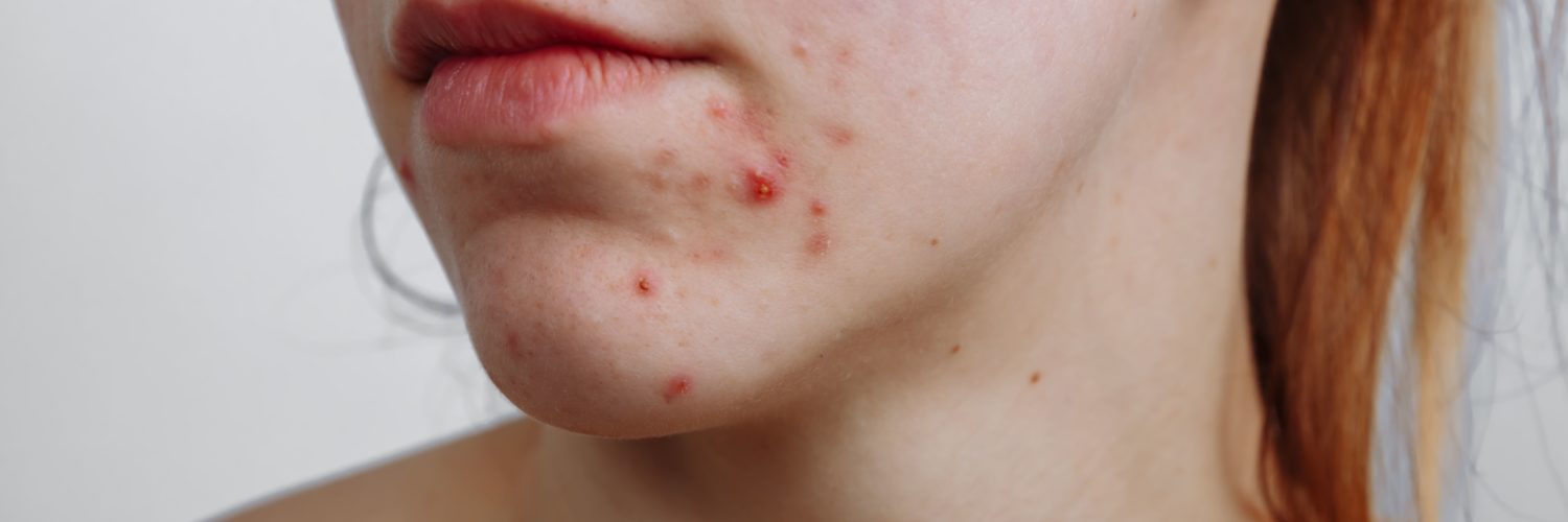 How do I stop pimples on my face?