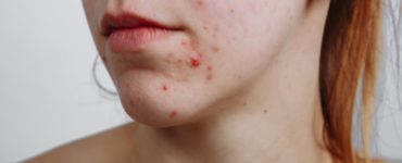 How do I stop pimples on my face?