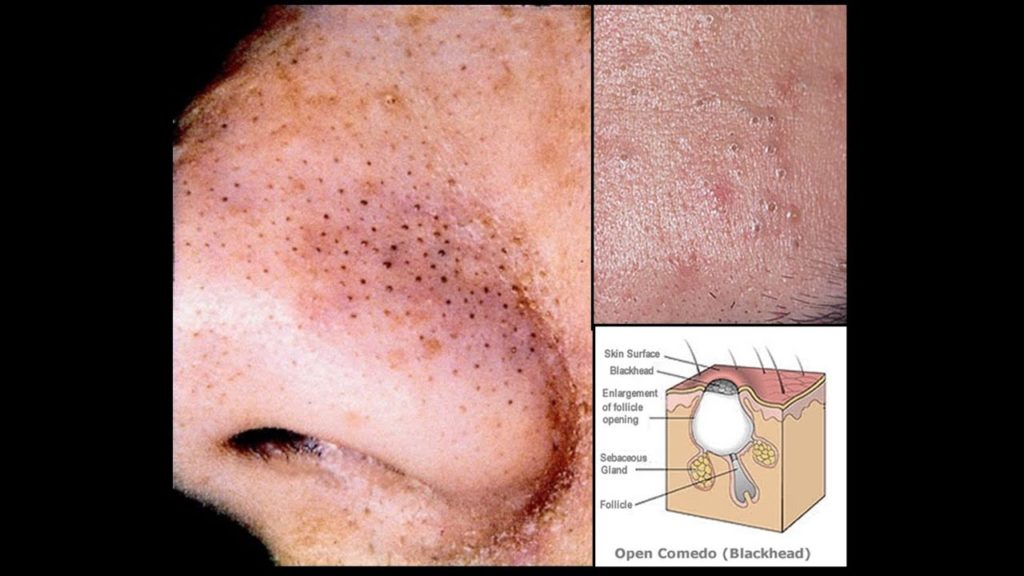 How do you draw out blackheads?