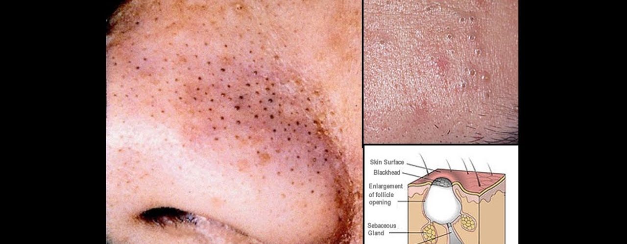 How do you draw out blackheads?