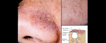 How do you draw out blackheads?