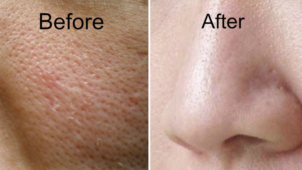 How do you get rid of dark pores?