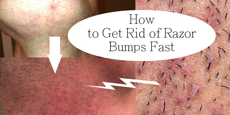 How do you get rid of razor bumps overnight?