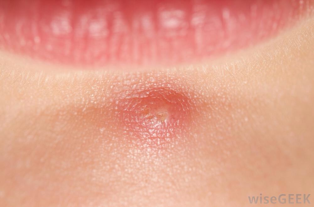 How do you pop a cystic pimple with no head?