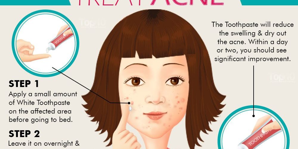 How do you treat an acne burn on your face?