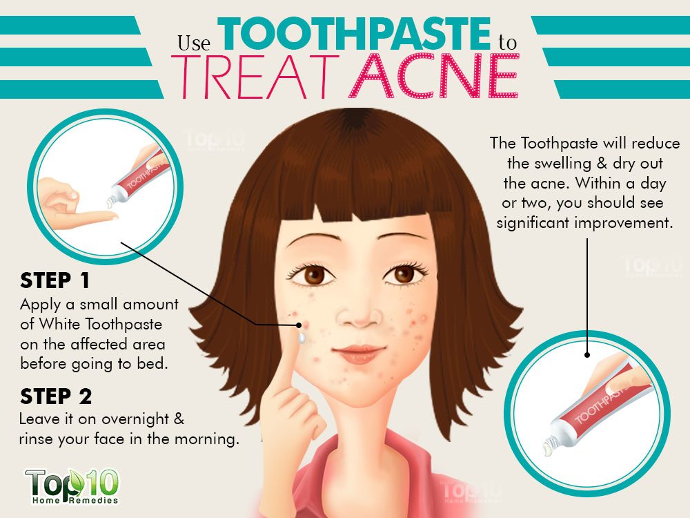 How do you treat an acne burn on your face?