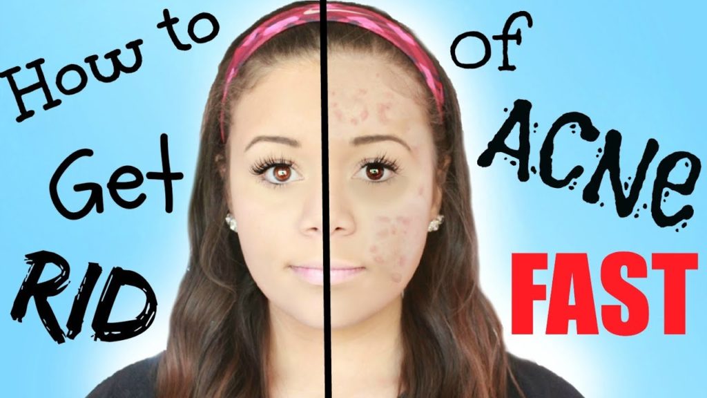 How get rid acne fast?
