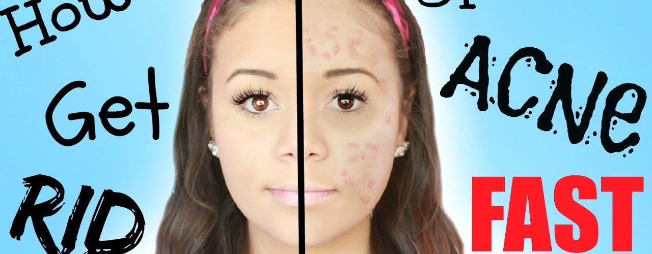 How get rid acne fast?