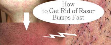 How get rid of razor bumps fast?