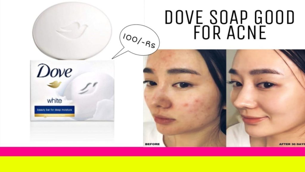 Is Dove soap good for pimples?