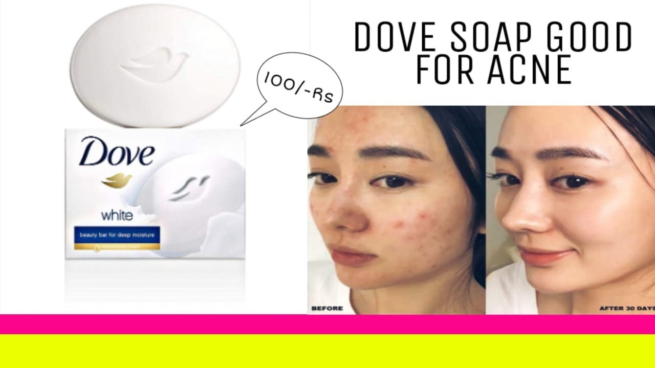 is-dove-soap-good-for-pimples