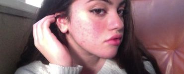 Is acne really unattractive?