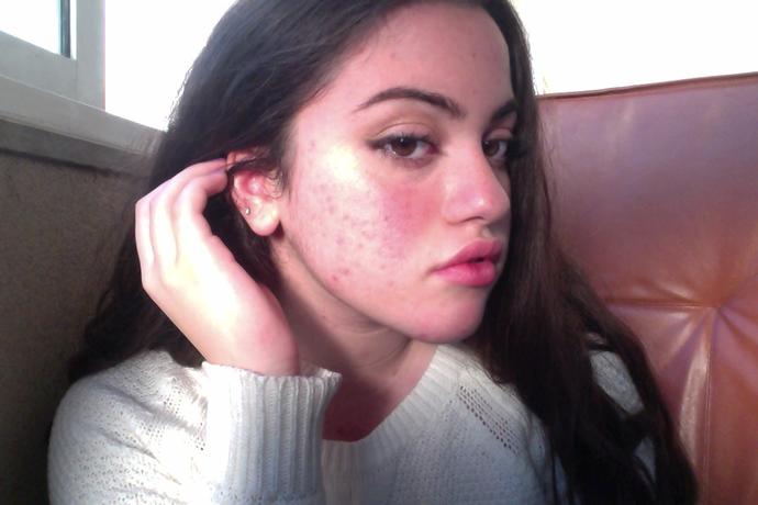 Is acne really unattractive?