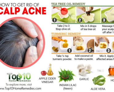 Is coconut oil good for scalp acne?
