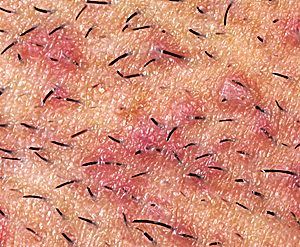 Is it normal to get pimples after shaving your pubes?