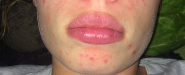 What age is acne the worst?