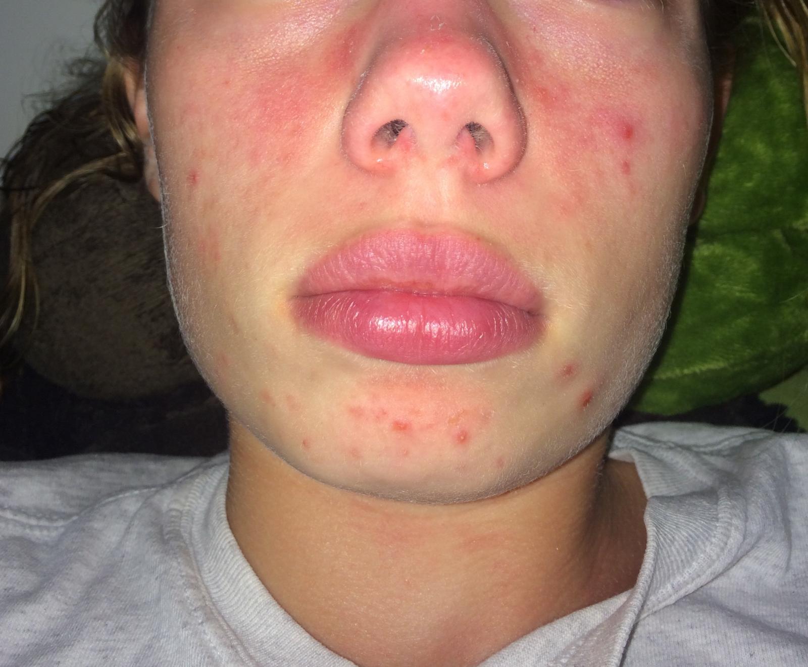 What Age Is Acne The Worst